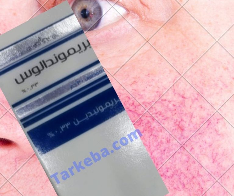 Read more about the article بريموندالوس جل 0.33% “Brimondalous” لعلاج احمرار الوجه “Rosacea”